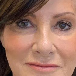 Non-Surgical Facelift Before & After Patient #11984
