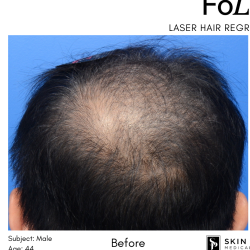 FoLix Before & After Patient #15026