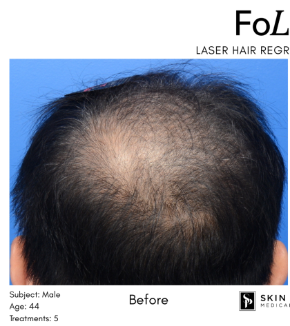FoLix Before & After Patient #15026