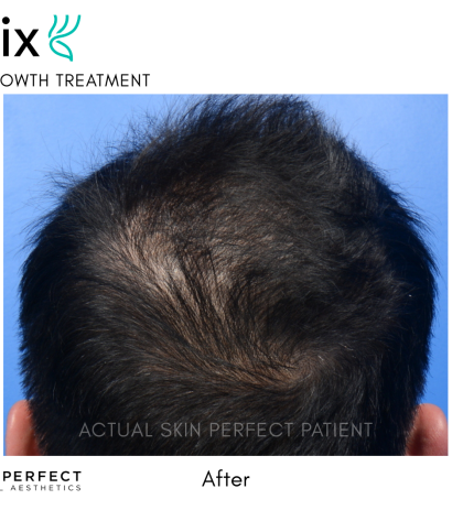 FoLix Before & After Patient #15026