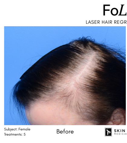 FoLix Before & After Patient #15027
