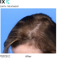 FoLix Before & After Patient #15027