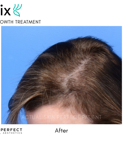 FoLix Before & After Patient #15027