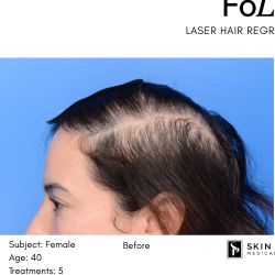 FoLix Before & After Patient #15028