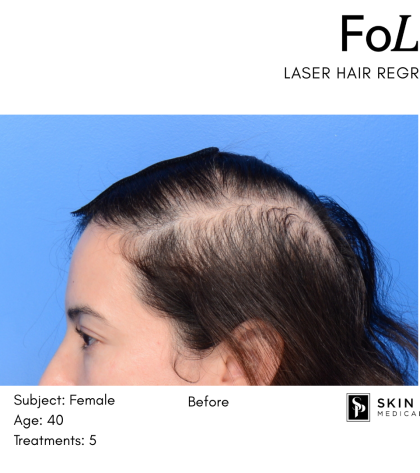 FoLix Before & After Patient #15028