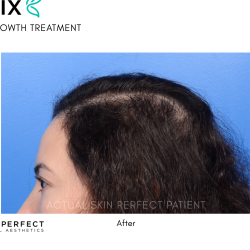 FoLix Before & After Patient #15028