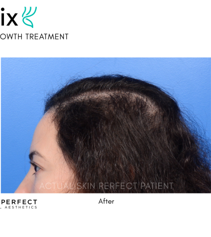 FoLix Before & After Patient #15028