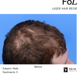 FoLix Before & After Patient #15029