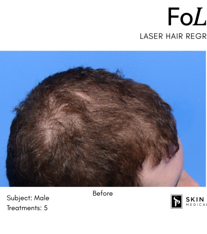 FoLix Before & After Patient #15029