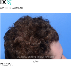FoLix Before & After Patient #15029