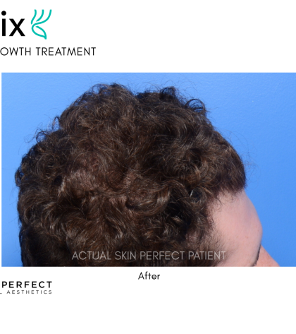 FoLix Before & After Patient #15029