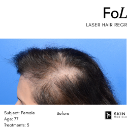 FoLix Before & After Patient #15030