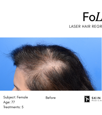 FoLix Before & After Patient #15030