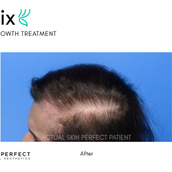 FoLix Before & After Patient #15030