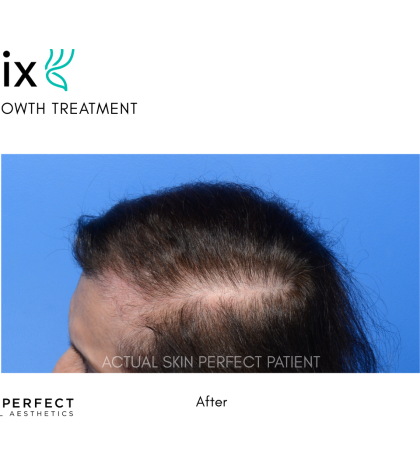 FoLix Before & After Patient #15030