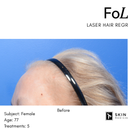 FoLix Before & After Patient #15031