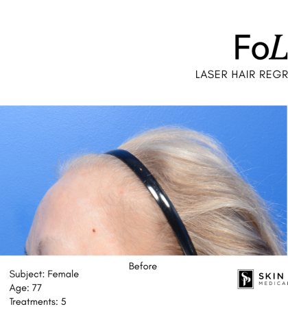 FoLix Before & After Patient #15031