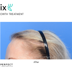 FoLix Before & After Patient #15031