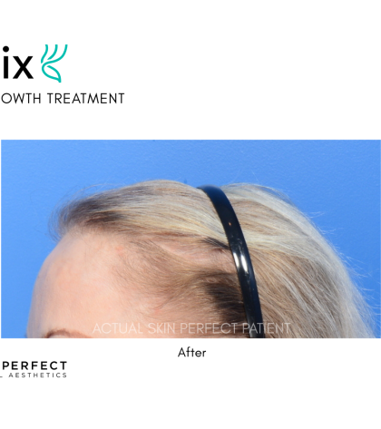 FoLix Before & After Patient #15031