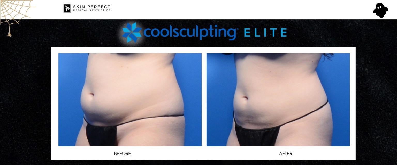 CoolSculpting Elite before and after results on the abdomen