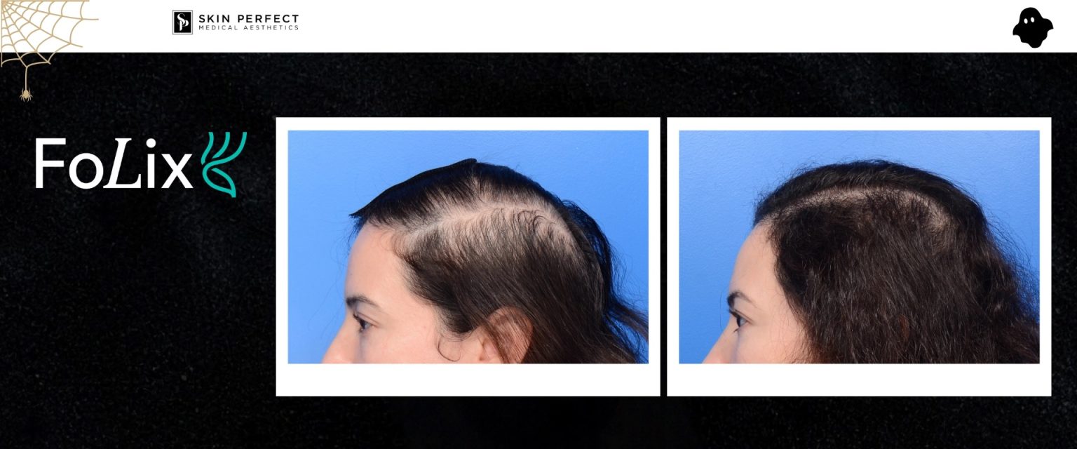 FoLix laser hair regrowth before and after on an actual Skin Perfect Glendora patient